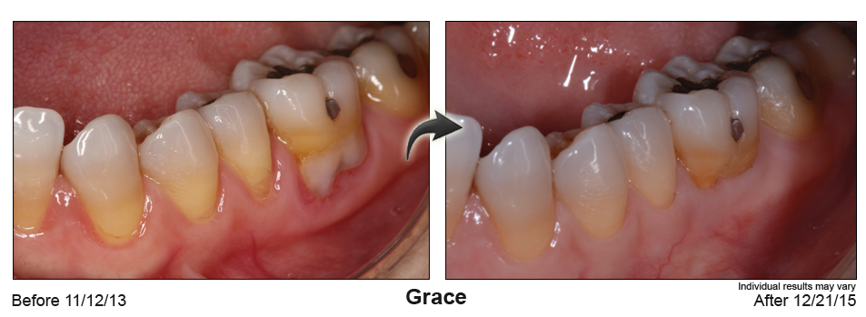 fix gum recession Picton Ontario