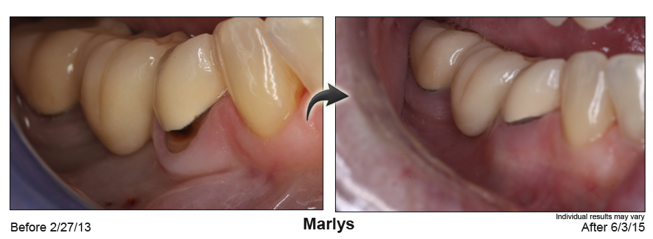 fix receding gums Picton Ontario